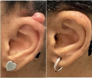 Ear Keloid Before and After