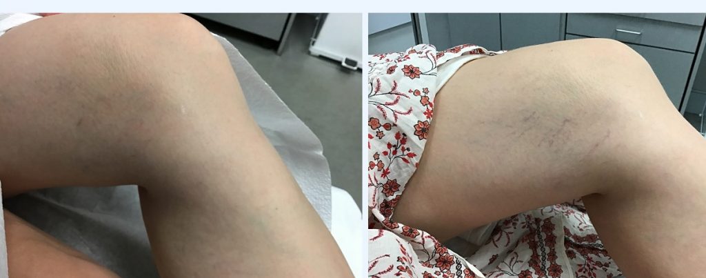 Leg Telangiectasia, before and after Vbeam