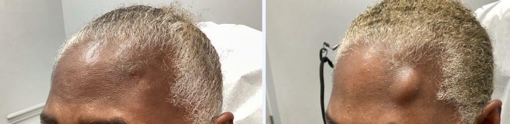 Lipoma removal at SOMA Skin & Laser in New Jersey