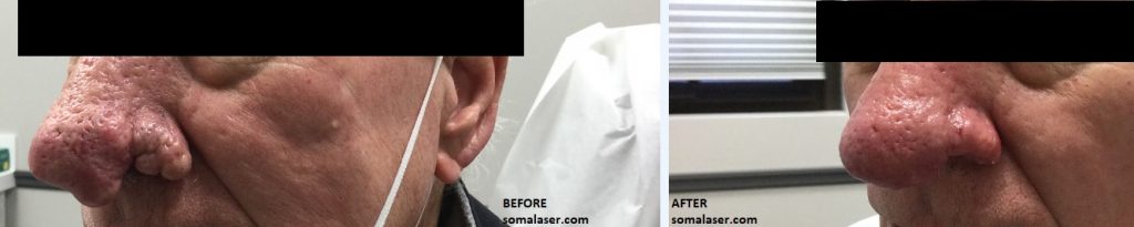 rhinophyma before and after