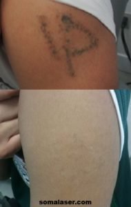 Laser Tattoo Removal Before & After