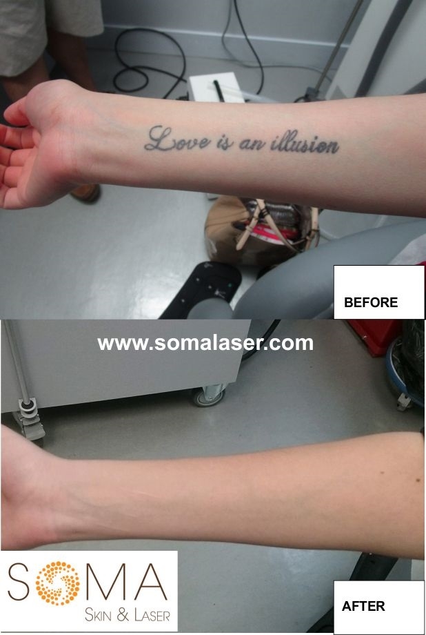 tattoo removal near me nj