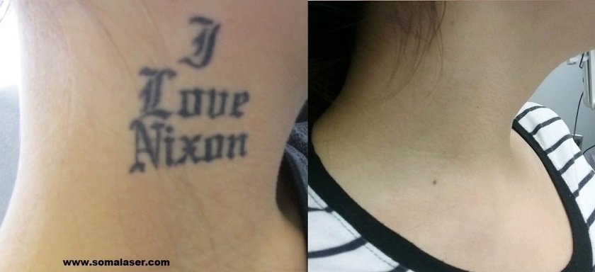 Laser Tattoo Removal Before &amp; After