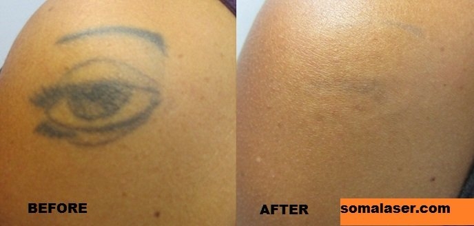 Laser Tattoo Removal In New Jersey Soma Skin Laser
