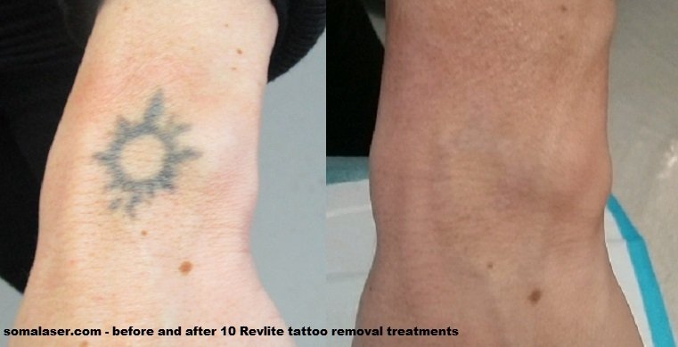 Laser Tattoo Removal Cost - Tattoo Ideas