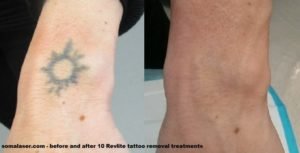 Before and after 10 Revlite laser tattoo removal sessions