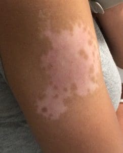 vitiligo-photo